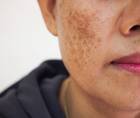 melasma