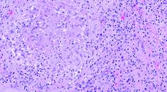 papules