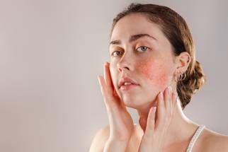 girl w rosacea