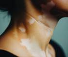 vitiligo