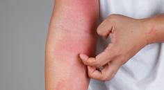 atopic dermatitis