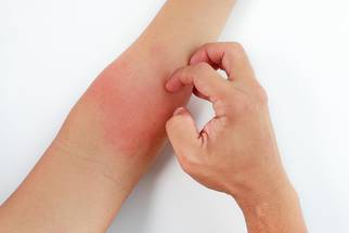 New Global Initiative Aims to Improve Eczema Care image