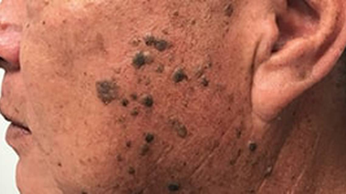 New Options for the Treatment of Extensive Seborrheic Keratosis image