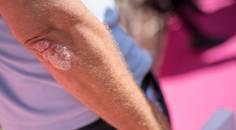 psoriasis