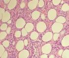 Erythema Induratum of Bazin