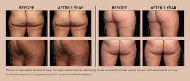 FDA Nod for Revelle Aesthetics Incs Avli for LongTerm Reduction in Cellulite image