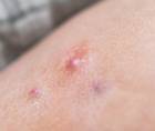 hidradenitis suppurativa