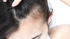 hair loss