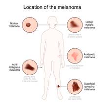 Revealed Key Genes That May Up Nodular Melanoma Risk image