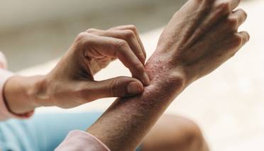 chronic hand eczema
