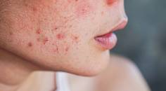 Acne vulgaris