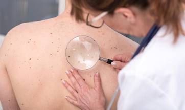 skin cancer