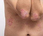 Psoriasis
