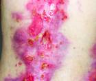 Epidermolysis Bullosa