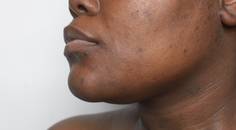hyperpigmentation