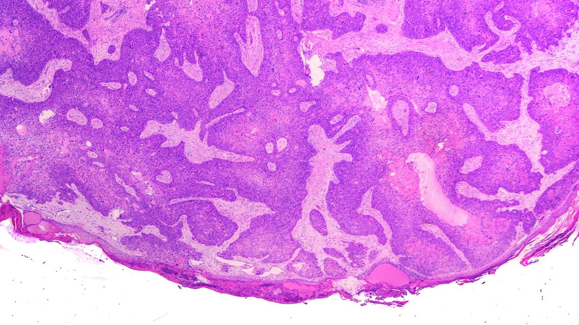 skin cancer