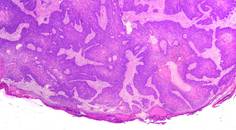 skin cancer