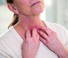 atopic dermatitis
