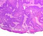 skin cancer