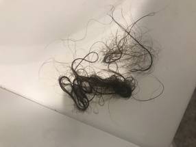 Dermatologists Seeing High Rates of Hair Loss after COVID19 image