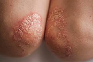 plaque psoriasis