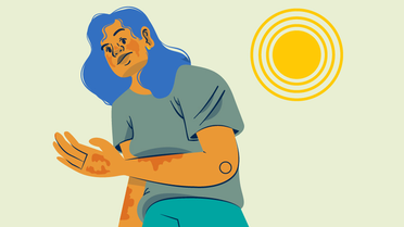 Healthyappearing Lupus Skin Predisposed to Flares Rashes image