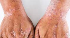 atopic dermatitis