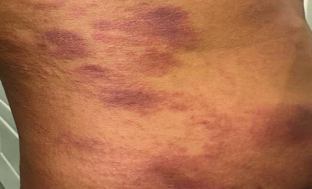 mycosis fungoides