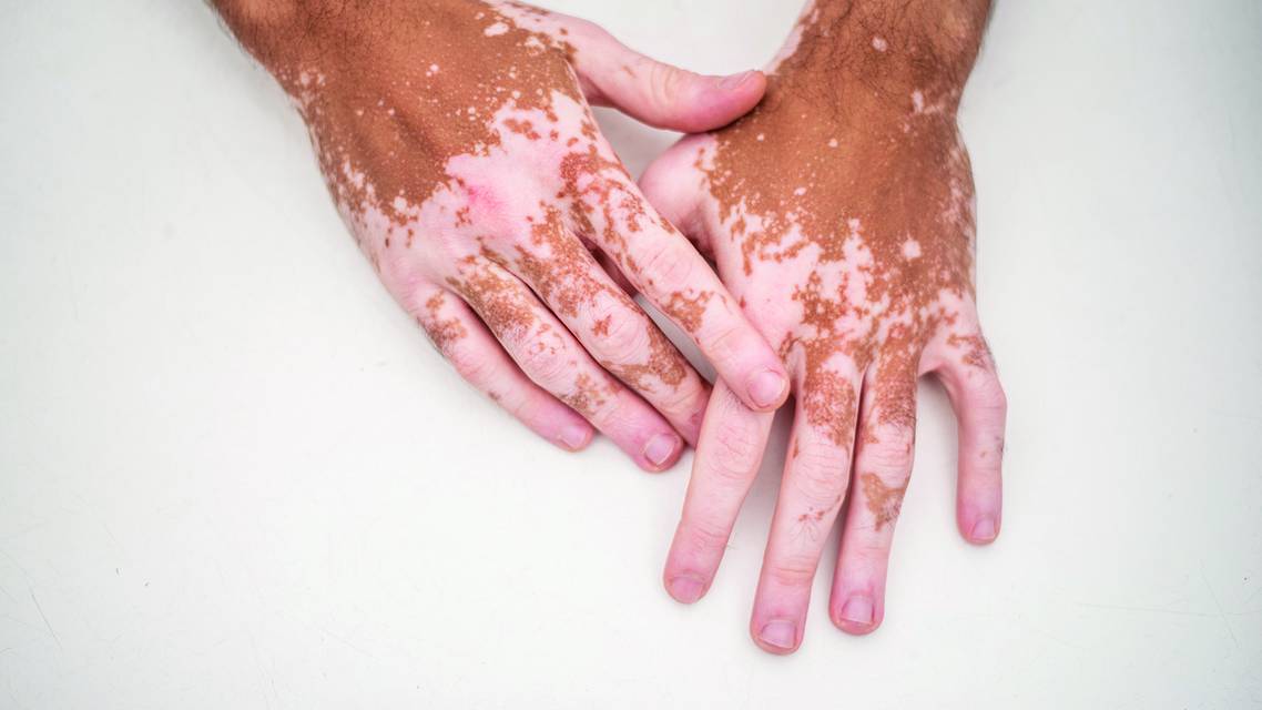 vitiligo