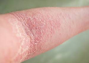 Atopic Dermatitis