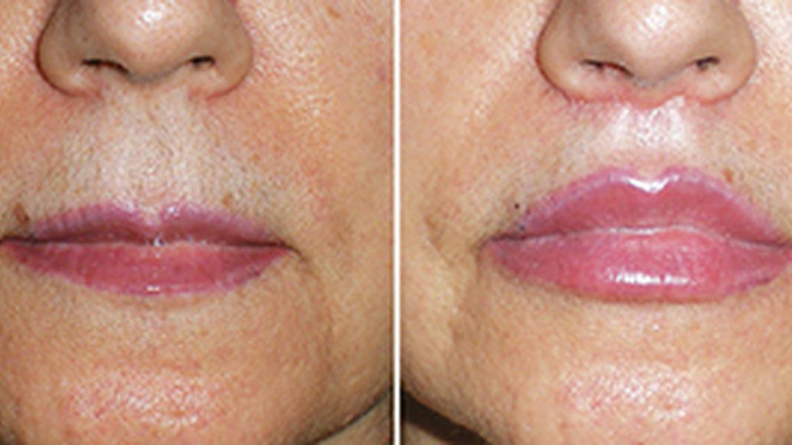 Lip Lifts A Procedure to Consider image
