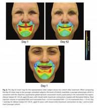Dermal Fillers Restore Youthful Facial Movement Too image