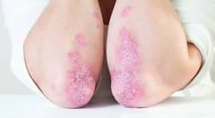 psoriasis