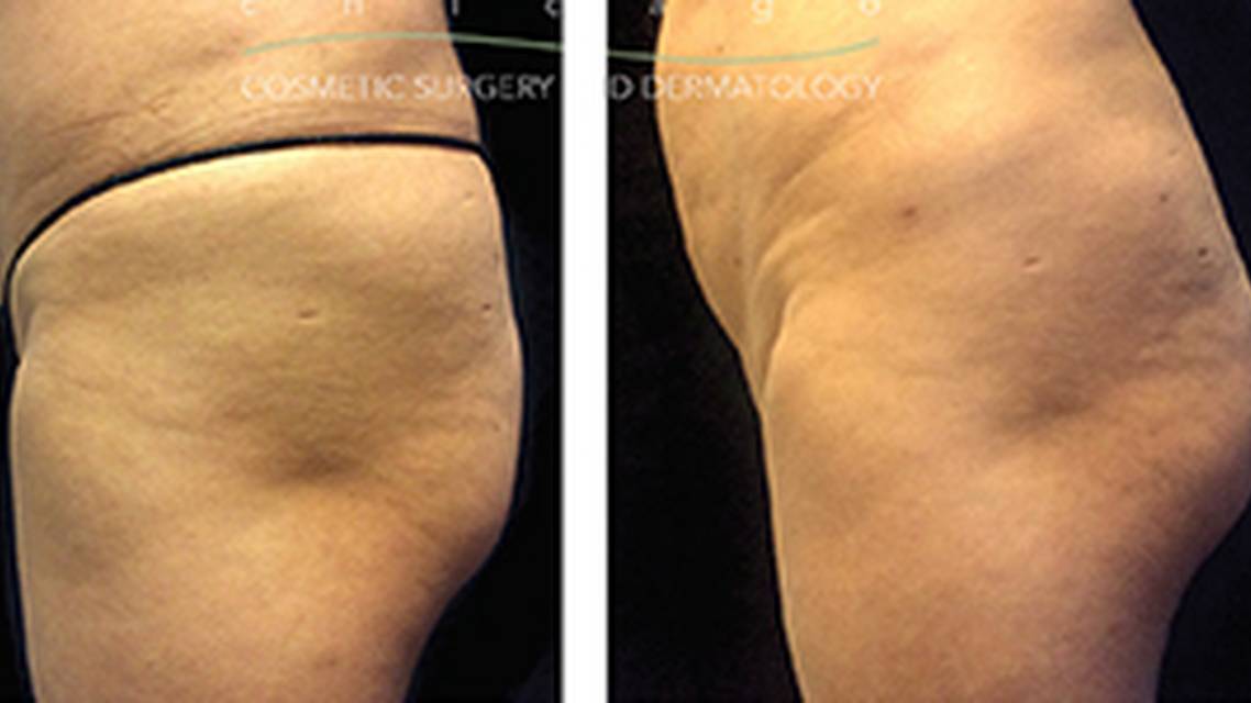 HIFEM Plus Biostimulator for Rounder Buttocks image