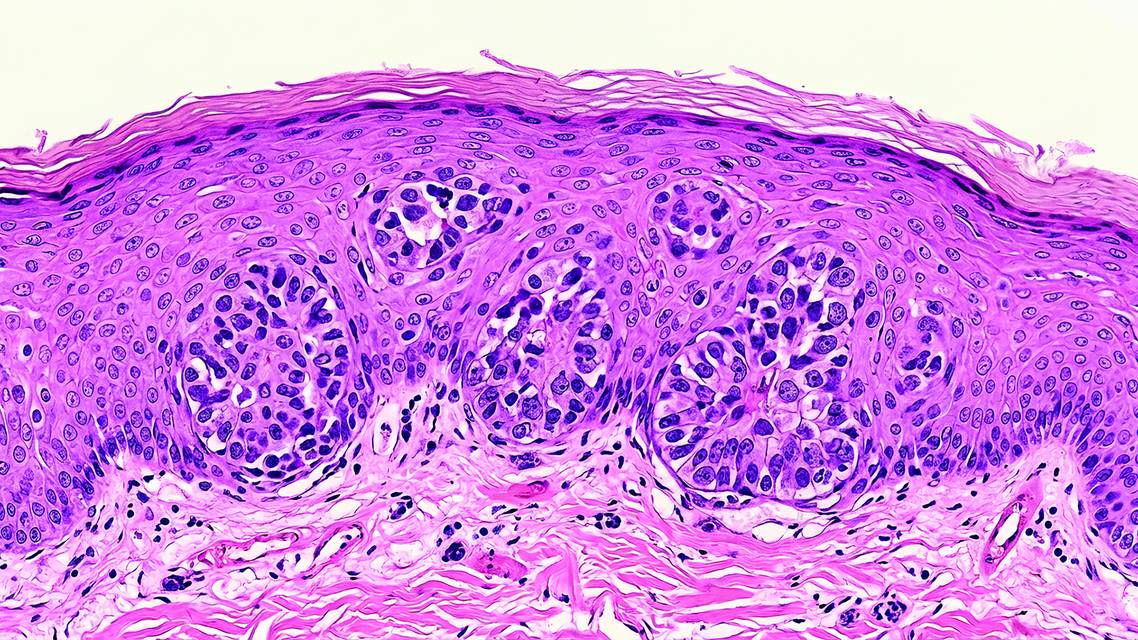 SKIN CANCER