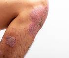 psoriasis