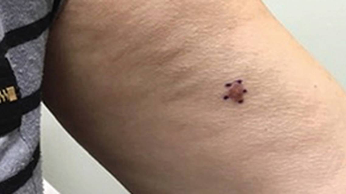 Gene Expression Profile Testing in the Management ofMalignant Melanoma image