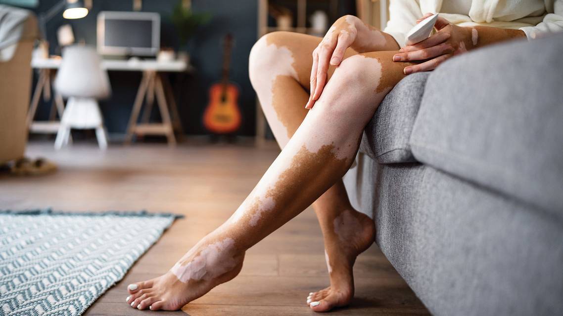 vitiligo