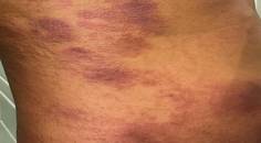 mycosis fungoides