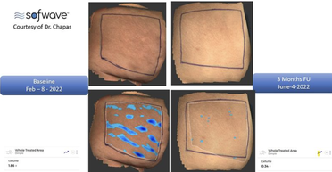 Sofwave Scores FDA Clearance to Improve Cellulite image