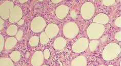 Erythema Induratum of Bazin