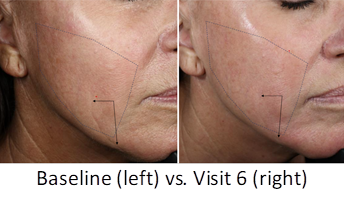 Jeune Aesthetics Announces Positive Clinical Phase 1 Efficacy Results for KB301 image