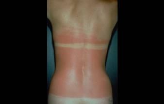AAD Sixty Percent of Americans Have Gotten Sunburned So Badly Their Clothes Were Uncomfortable image