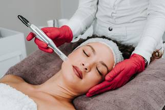 microneedling