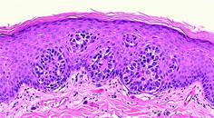 SKIN CANCER