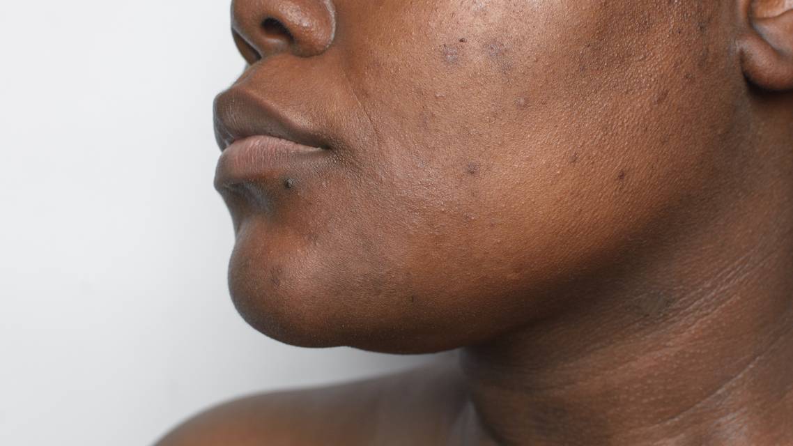 hyperpigmentation