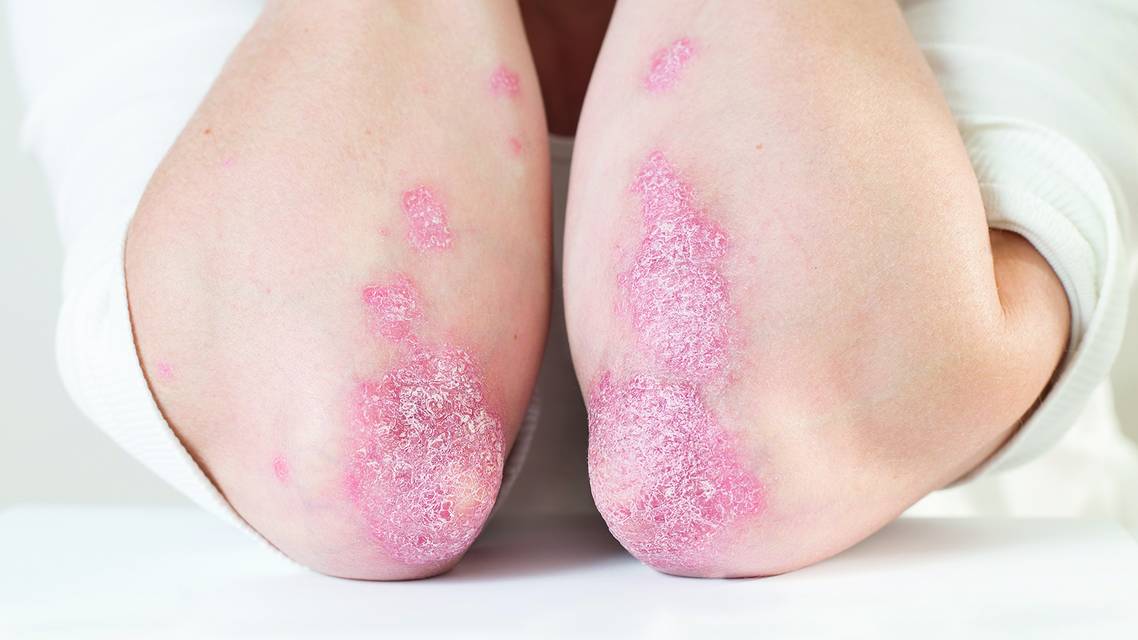 psoriasis