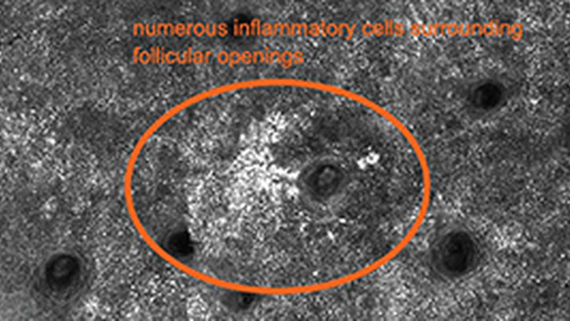 An Introduction to Reflectance Confocal Microscopy image
