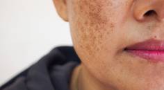 melasma