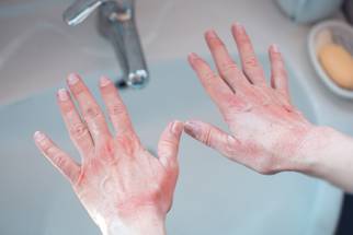 EMA Accepts LEO Pharmas MAA for Delgocitinib Cream in Chronic Hand Eczema image